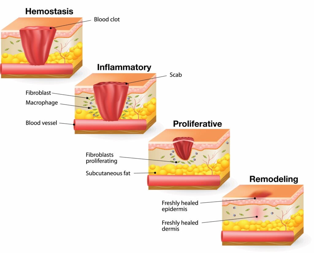 Four stages of wound healing